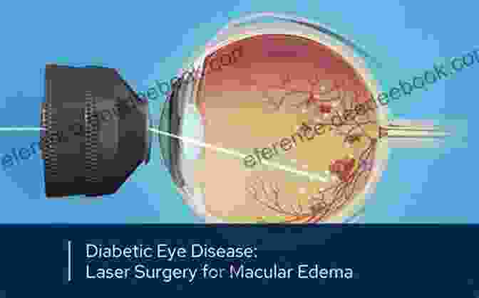 Macular Degeneration Treatment Being Performed On A Patient's Eye Recent Advances In Ophthalmology 15 Nitin Nema